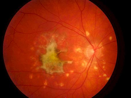 Augenhintergrundaufnahme mit sichtbarer Narbe im Bereich der Netzhaut, verursacht durch eine Uveitis.